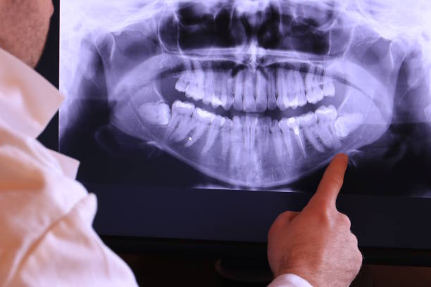 Best Knocked-Out Tooth (Avulsed Tooth) Treatment in Tremont, PA
